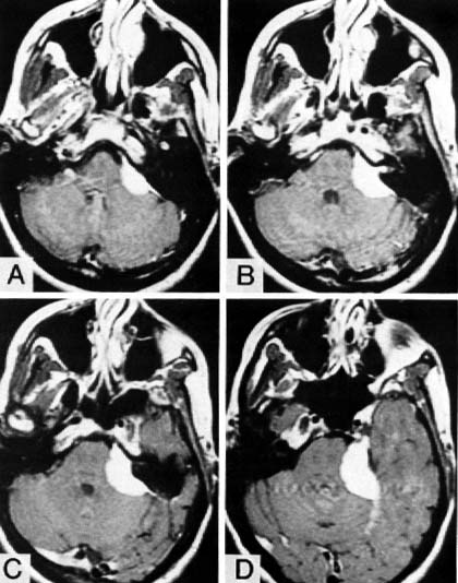 MRI of Meningioma