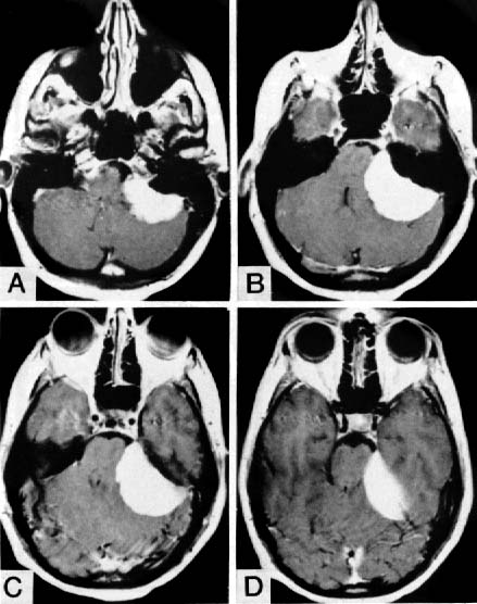 MRI of Meningioma